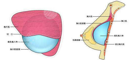  How about Beijing Shengjiaxin breast augmentation