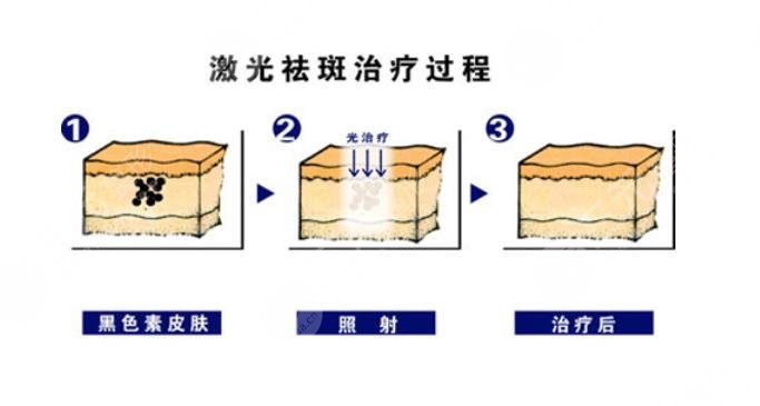  How about laser freckle removal in Guangzhou Nanfang Hospital