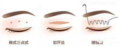  How about the double eyelids of Xuzhou Third Hospital