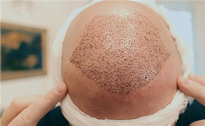 毛发移植手术不是使毛发再生,而是把现有健康毛囊资源进行合理再分配
