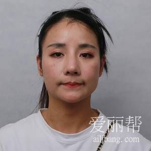 上海时光整形医院做下颌角整形V脸手术分享