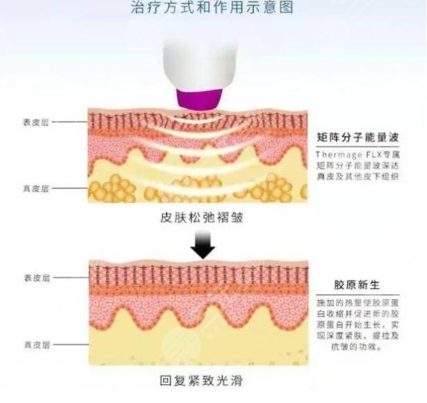 南京华美做热玛吉效果怎么样