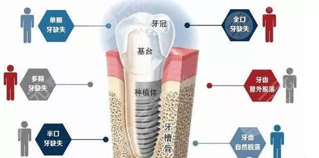 广州市第一人民医院种植牙齿价格表新