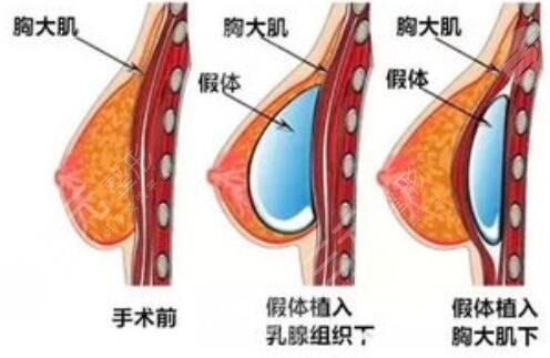 隆胸手术那家医院好