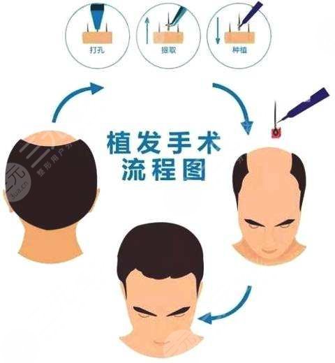 杭州市第一人民医院植发怎么样