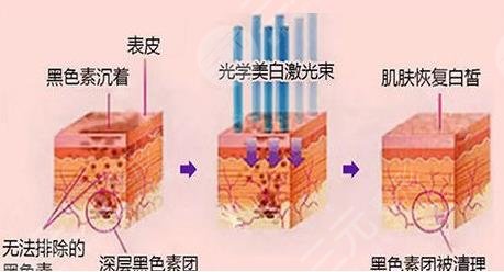 国内光子嫩肤公立医院排名