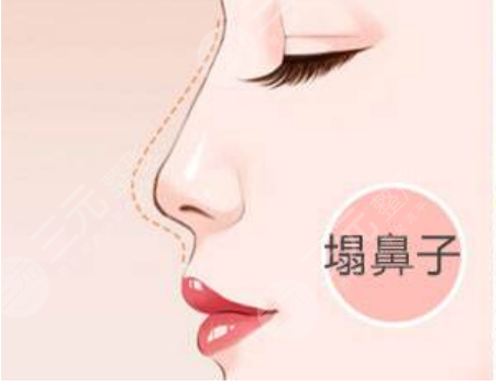 在北京炫美做的隆鼻整形手术