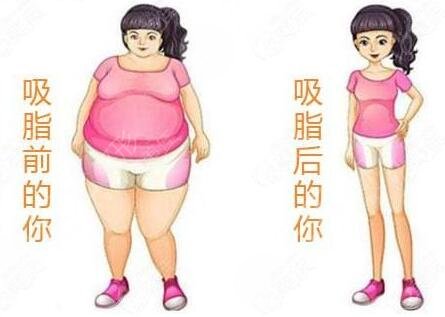 上海九院大腿吸脂+自体脂肪隆胸果分享