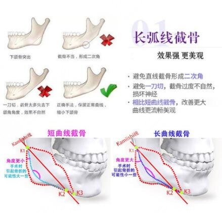 上海伊莱美整形医院磨骨怎么样