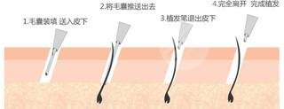 广东省人民医院植发是外包的吗