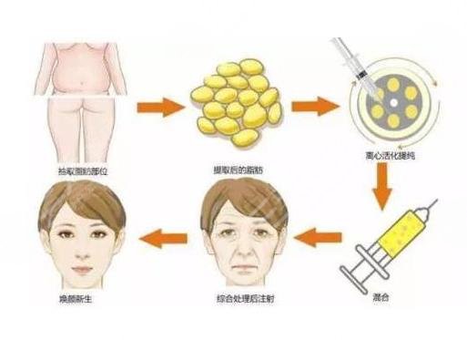 北京脂肪填充医院排名