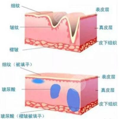 內(nèi)窺鏡除皺手術(shù)哪家醫(yī)院能做了