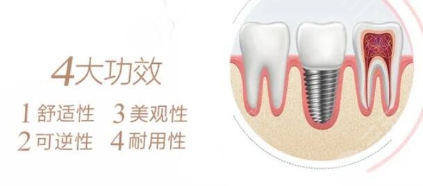 上海哪个医院种植牙比较好