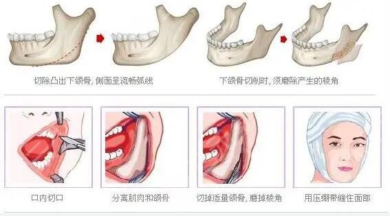 成都華西口腔醫(yī)院磨骨怎么樣