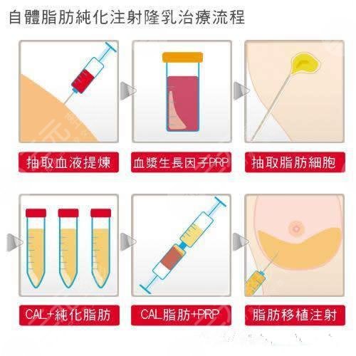 北京自体脂肪丰胸医院排名