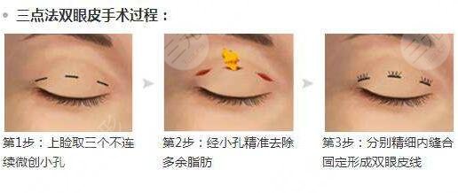 上海丽质医疗美容做双眼皮怎么样