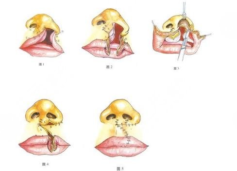 華西醫(yī)院唇腭裂修復(fù)能到看不出來(lái)嗎