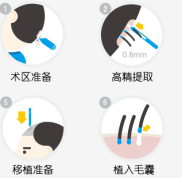 植發(fā)去正規(guī)醫(yī)院還是專業(yè)機(jī)構(gòu)