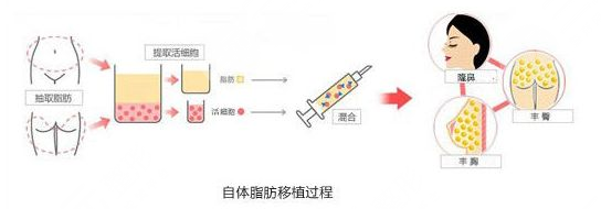 深圳美莱做自体脂肪填充面部整形实例和热门项目价格表