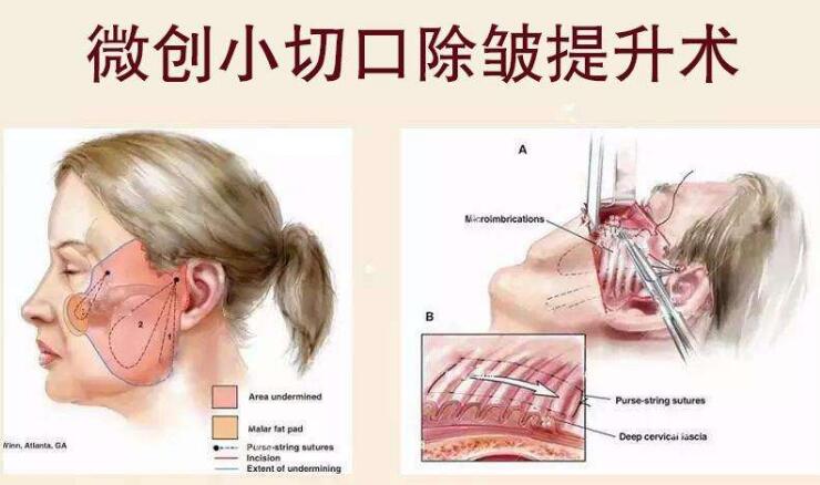 全國(guó)拉皮手術(shù)哪里做的好