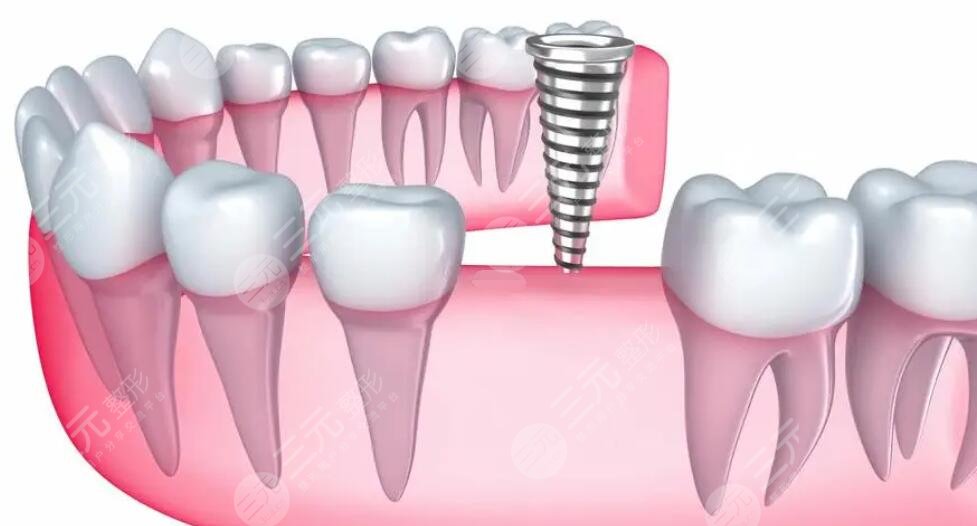 2022上海哪家医院种植牙便宜又好