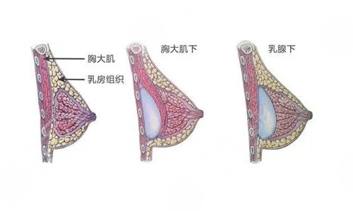 深圳美莱做胸比较好的医生排名