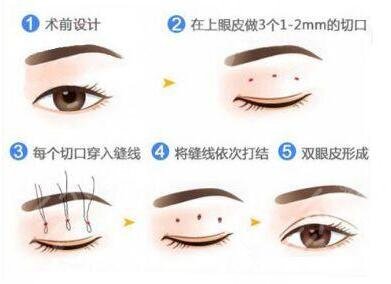 北京八大处医院双眼皮修复专家排名