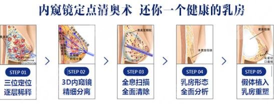 广州奥美定取出荔湾区人民医院怎么样