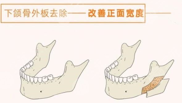 上海磨骨醫(yī)院排名