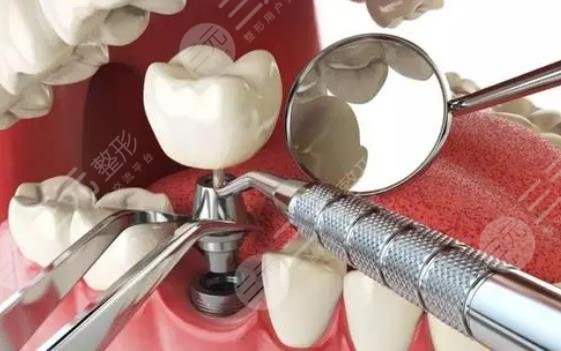 一般种植牙能用几年