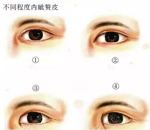 2020淮安第一人民医院做双眼皮价位表