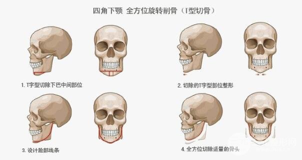 北京八大处下颌角专家有哪些