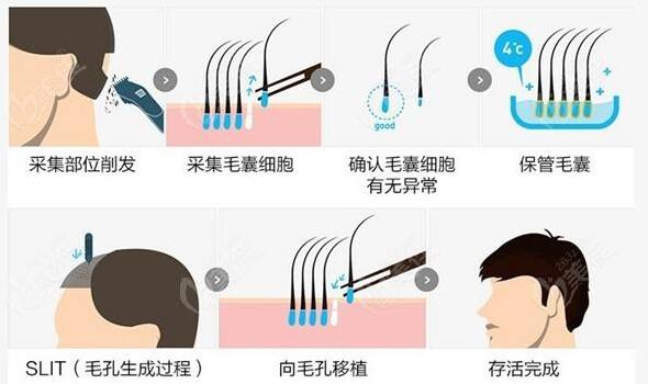 蘭大一院植發(fā)怎么樣