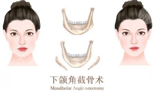 上海首爾麗格做下頜角怎么樣