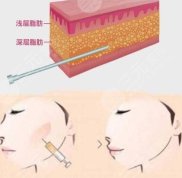 合肥恒美美容醫(yī)院自體脂肪填充怎么樣、多少錢