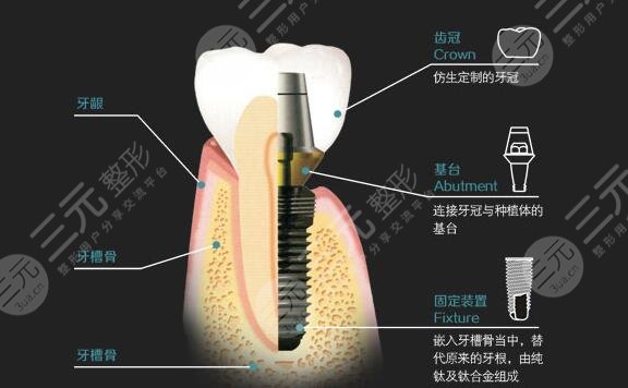 兰州种植牙哪家医院好