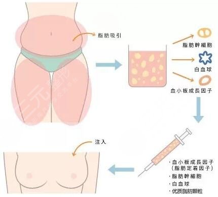 广州隆胸专家前十名名单公布