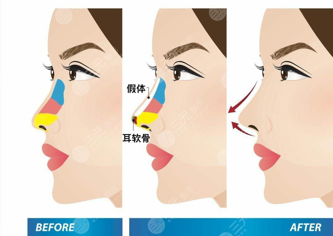 北京亚峰整形美容医院鼻部整形手术怎么样、价格多少