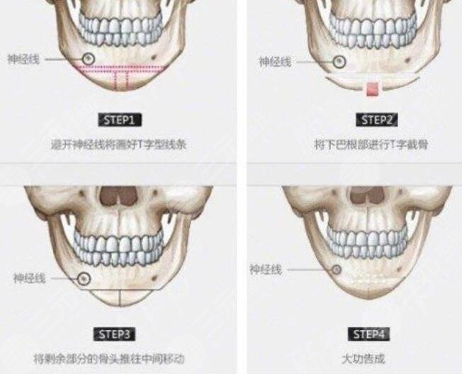 八大處下頜角手術(shù)哪個(gè)醫(yī)生好