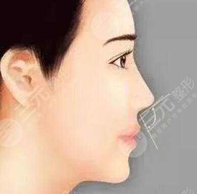 北京亚峰整形美容医院鼻部整形手术怎么样、价格多少