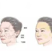 沈陽自體脂肪填充多錢