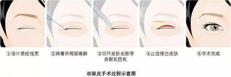 郑州双眼皮医院排行榜前5都是哪几家