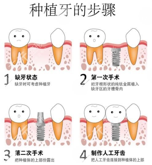 上海种牙医院排名清单来袭