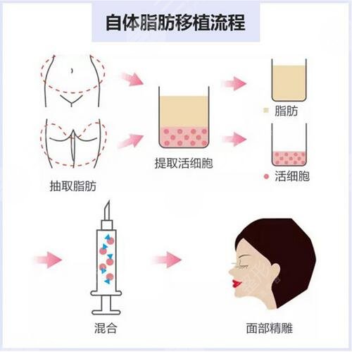 上海九院脂肪填充技术成熟吗