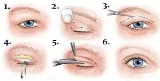 深圳割双眼皮医院哪家好