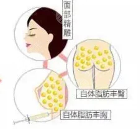 上海欧华国j医疗美容自体脂肪移植全新价目表曝光