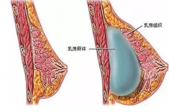 郑州假体隆胸技术好的医生盘点