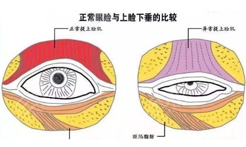 上瞼下垂幾歲做手術(shù)好