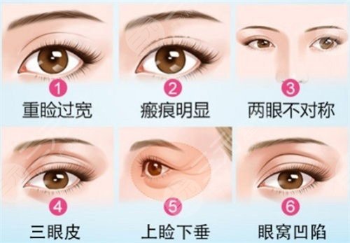 上海九院张路双眼皮技术怎么样