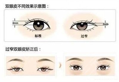 北京双眼皮修复专家排名名单公布